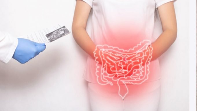 Cáncer de colon: especialistas sugieren actualizar las Guías Clínicas Ges