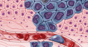 Aumenta cáncer colorrectal y hepático en Chile Ilustración de células cancerígenas